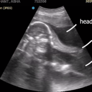 Adorable Ultrasound Of A Baby Elephant Goes Viral